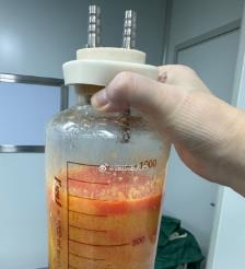 云南水动力吸脂手术要做多久？